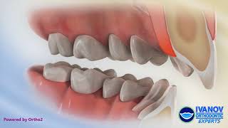 Teeth Before and After Overbite Fix with Braces [upl. by Ardnekan]