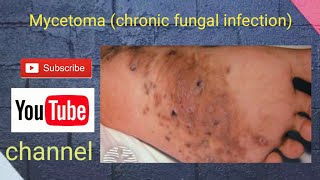 Mycetoma chronic fungal infection [upl. by Katey]