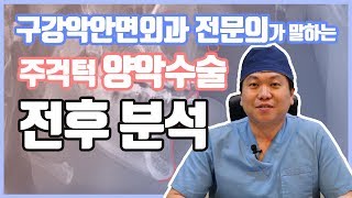 구강악안면외과 전문의s 주걱턱 양악수술 전후로 분석하기 ㅣ 줌구강악안면외과 [upl. by Ataga]