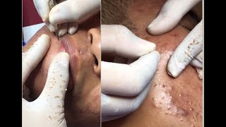 Best Pimple Popping 14 beautiful blackheads sacdepspa [upl. by Eeliab]