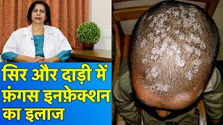 सिर और दाड़ी के फ़ंगस इनफ़ेक्शन का इलाज  Treatment of Fungal Infections In Beard amp Scalp [upl. by Oilime]