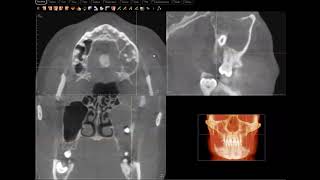 Odontogenic keratocyst OKC  KOT confirmed [upl. by Samuela]