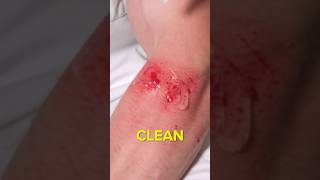 Does Hand Sanitizer Burn an Open Wound funny science comedy [upl. by Alek145]