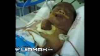 Baby born with its heart OUTSIDE his body very sad [upl. by Monah947]