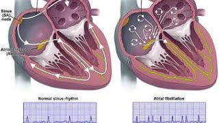 Atrial Fibrillation [upl. by Gnouhp]