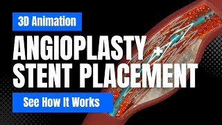 How Angioplasty and Stent Placement Works  3D Animation [upl. by Ard]