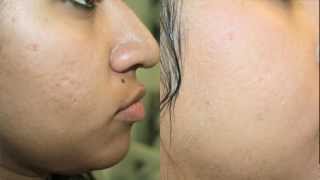 Dark Skin Acne Scar Removal [upl. by Ellicott423]