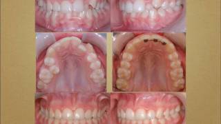 Cas traités en orthodontie orthodontistes Lemaymov [upl. by Inig815]