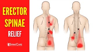 How to Fix Erector Spinae Pain FOR GOOD [upl. by Appleby]