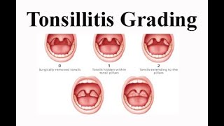 Tonsillitis Grading [upl. by Oriole]