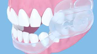 SleepRight DuraComfort Dental Guard Features [upl. by Zielsdorf]