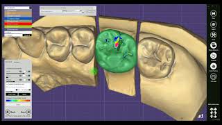 How to design a Pressed Crown in exocad [upl. by Steffy433]