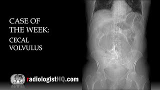 Case of the Week Cecal Volvulus Xray amp CT [upl. by Bernadette907]