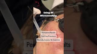 Acne Scar Treatment using RF Microneedling  Results Shown [upl. by O'Donoghue]