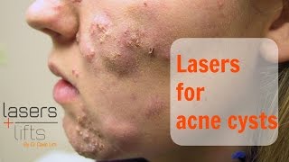 Treating acne cysts [upl. by Batchelor]