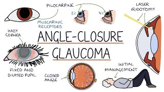 Understanding Acute Angle Closure Glaucoma [upl. by Grizelda725]