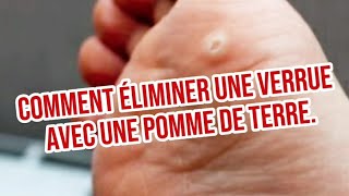 Comment Éliminer une Verrue avec une Pomme de Terre [upl. by Wassyngton]