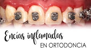 ENCÍAS INFLAMADAS CON ORTODONCIA  CAUSAS Y TRATAMIENTO [upl. by Acinaj]