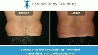 Does CoolSculpting Work  Real Love Handle Results [upl. by Benkley73]