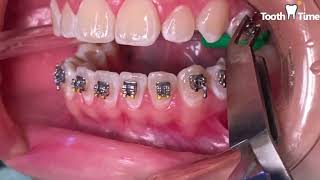 How they put braces on  13 years old patient  Tooth Time Family Dentistry New Braunfels Texas [upl. by Lichtenfeld]