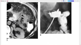 COLON IMAGING EXAM CASES GIT MAYO CLINIC [upl. by Nashner315]