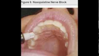 NP nasopalatine nerve block [upl. by Haroved]