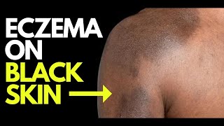 Doctor explains what ECZEMA looks like on BLACK SKIN  plus photos diagnosis and treatment [upl. by Borg]