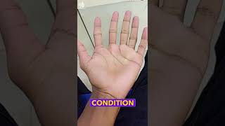 Woke Up with an Extra Finger The Truth Behind Viral Polydactyly Videos [upl. by Caraviello]