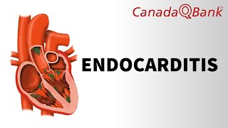 Endocarditis [upl. by Vizzone101]