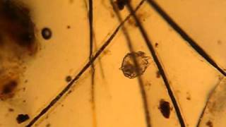 Sarcoptes scabiei mite under the microscop light [upl. by Ecnarrot216]