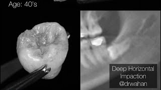 Deep Horizontal Impacted Third Molar Extraction with LPRF Plug [upl. by Ferullo345]