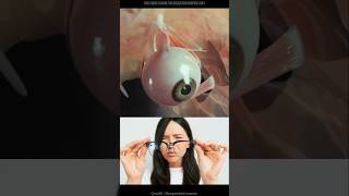 Lasik eye surgery shortsfeed [upl. by Llenwad]