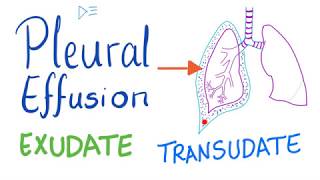 Pleural Effusion  Transudate or Exudate  Causes and Liddle’s Criteria Pulmonary Medicine Playlist [upl. by Juta]