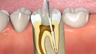 ProPoint How to obturate a root canal with SmartSeal [upl. by Stafani]