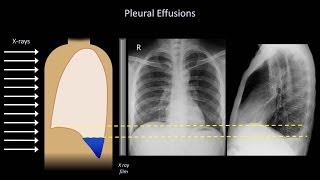 How to Interpret a Chest XRay Lesson 6  Diaphragm and Pleura [upl. by Eiramlatsyrk]