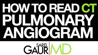 How to Read a CT Pulmonary Angiogram CTPA or PE Study [upl. by Happy305]