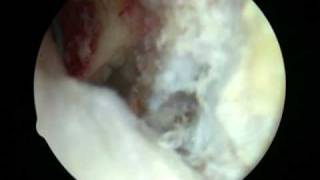 Dr Cascio Knee Arthroscopy 3 of 3 Anatomic ACL reconstruction [upl. by Nhepets735]