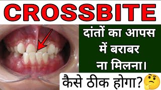 Crossbite Dental Condition 🦷  Cause Problem and Treatment [upl. by Nan]