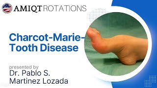 POLYNEUROPATHYCHARCOT MARIE TOOTH DISEASE Pablo Martinez Lozado [upl. by Rebna]