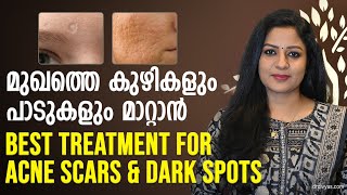 മുഖത്തെ കുഴികളും പാടുകളും മാറ്റാൻ Best treatment for Acne Scars amp dark spots  Remove acne scars [upl. by Aufmann]