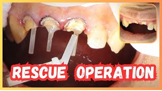 Broken Front Teeth Rebuilding cost with Zirconia and Emax crowns without Tooth Implant [upl. by Leira]