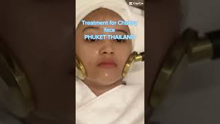 Treatment for chubby face in Phuket Thailand [upl. by Bensen]