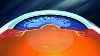 Advance Glaucoma Treatment  Canaloplasty [upl. by Tynan528]