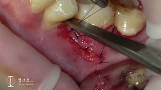 Modified Lateral Pedicle Flap for Augmentation of Keratinized Gingiva at Mandibular Molar VI [upl. by Avis]