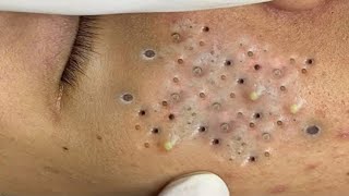 Blackheads amp Whiteheads Satisfying Removal 0284 [upl. by Lertnom]