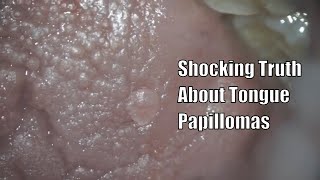 Shocking Truth About Tongue Papillomas dentist teeth dental cavity dentistry veneers tooth [upl. by Akired]