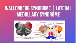 Wallenberg Syndrome  Lateral Medullary Syndrome  PhysiotherapyKnowledge [upl. by Caressa]