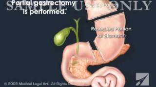 RouxenY Gastric Bypass Surgery [upl. by Abrahams]