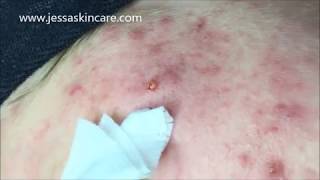 Acne Treatment Extractions  Acne Facial Protocol  Esthetician Education [upl. by Farro]