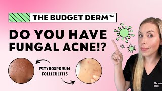 5 Signs You Have Fungal Acne…NOT Regular Acne  The Budget Derm Explains [upl. by Kinchen289]